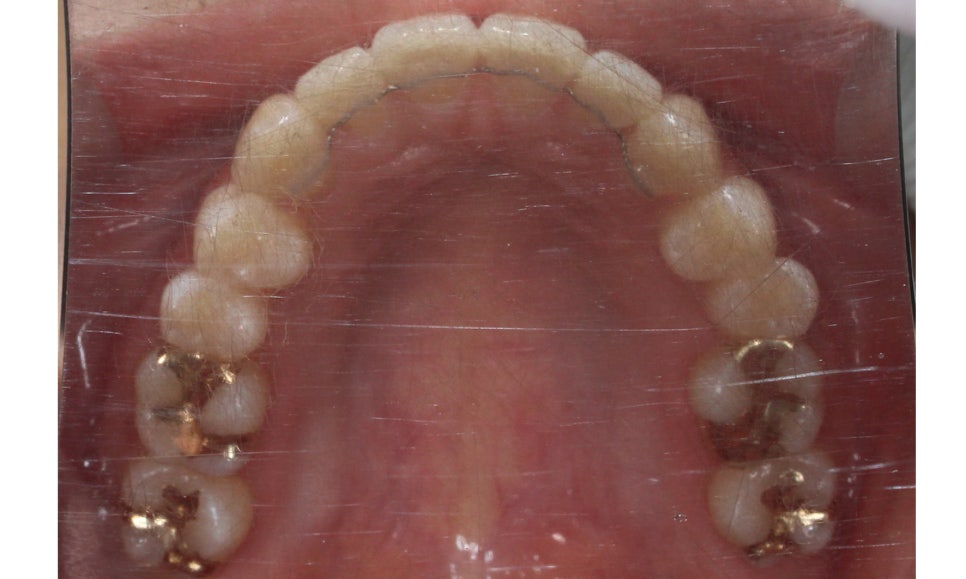 신논현치과 자가결찰브라켓 장점 관련 이미지 15