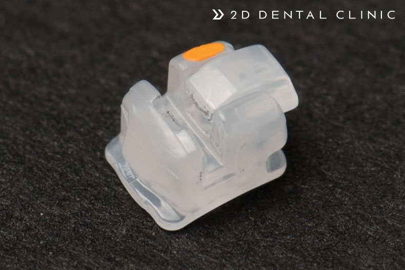 앞니 부분교정 전체교정 비교, 강남 2D치과 관련 이미지 10