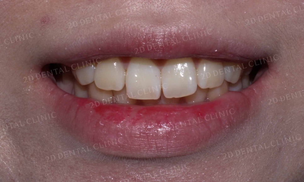 강남역 치과에서 앞니부분 설측 2D(투디)교정으로 토끼앞니 탈출한 후기 관련 이미지 10