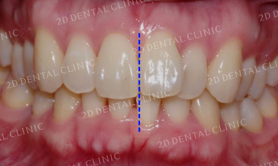 [투디교정] 부정교합 앞니교정을 투디교정으로 고르게! by.투디치과(2D치과) 관련 이미지 5