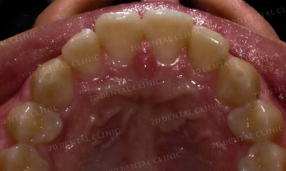 [앞니교정] 벌어진 앞니, 부분교정으로 앞니교정하기! by.2D치과(투디치과) 관련 이미지 16