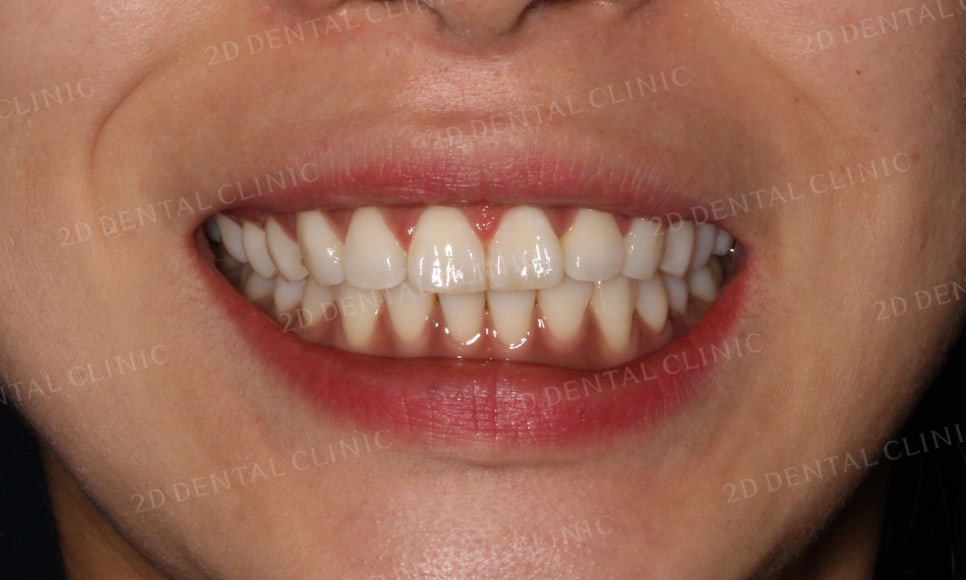 [부분교정] 틀어진 앞니, 부분교정으로 앞니교정하기! by.투디치과(2D치과) 관련 이미지 13