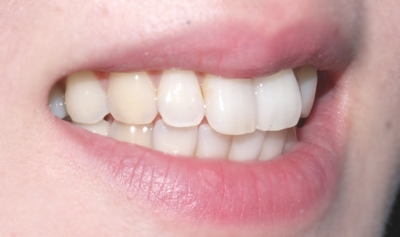 결혼식 6개월 남기고 급속교정으로 토끼이빨 탈출! 관련 이미지 2