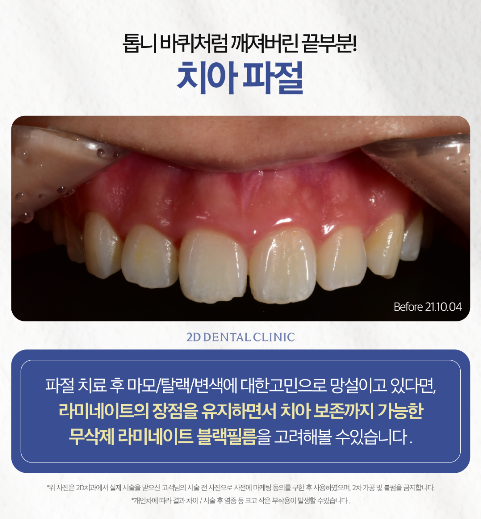 무삭제라미네이트가격 치아파절치료 깨진 이 개선 방법은? 관련 이미지 3