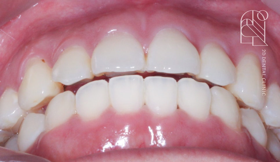 부정교합 치아교정, 전체교정으로 완성하기! by. 투디치과(2D치과) 관련 이미지 9