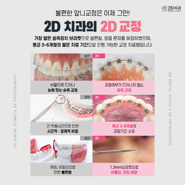 바쁜데 치아 교정 가능? 2D의 앞니교정은 가능! 관련 이미지 2
