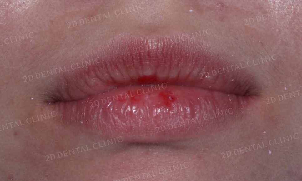 강남역 치과에서 앞니부분 설측 2D(투디)교정으로 토끼앞니 탈출한 후기 관련 이미지 9