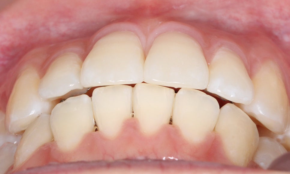 신논현치과 자가결찰브라켓 장점 관련 이미지 11