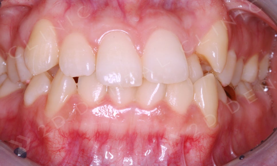 덧니만 부분교정으로 교정 할 수 있나요? 관련 이미지 7