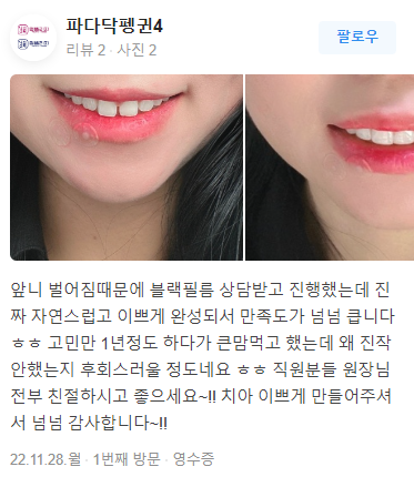 무삭제 라미네이트 비용 알아보기 ! 관련 이미지 6