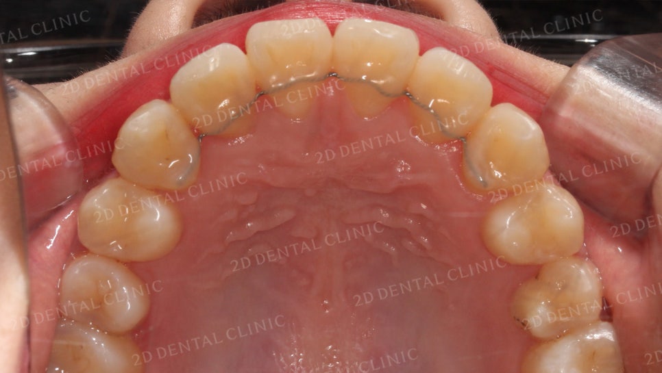 덧니치아교정, 클리피씨 전체교정으로 완벽하게! by.투디치과(2D치과) 관련 이미지 17