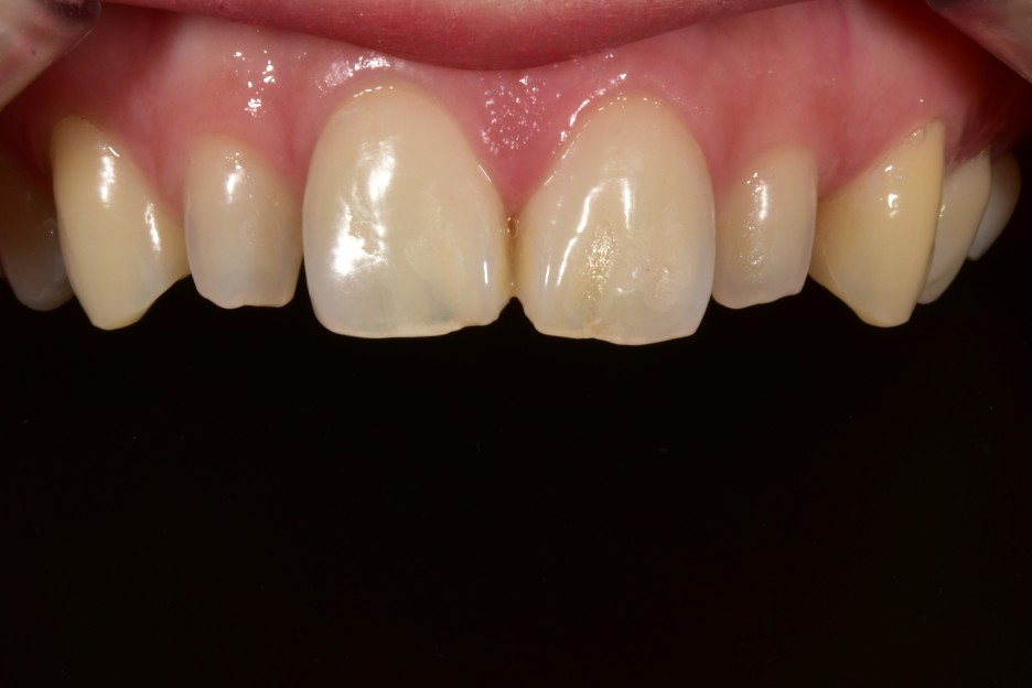 [투디치과] 블랙필름(비스포크) 치료의 다양한 사례 관련 이미지 19