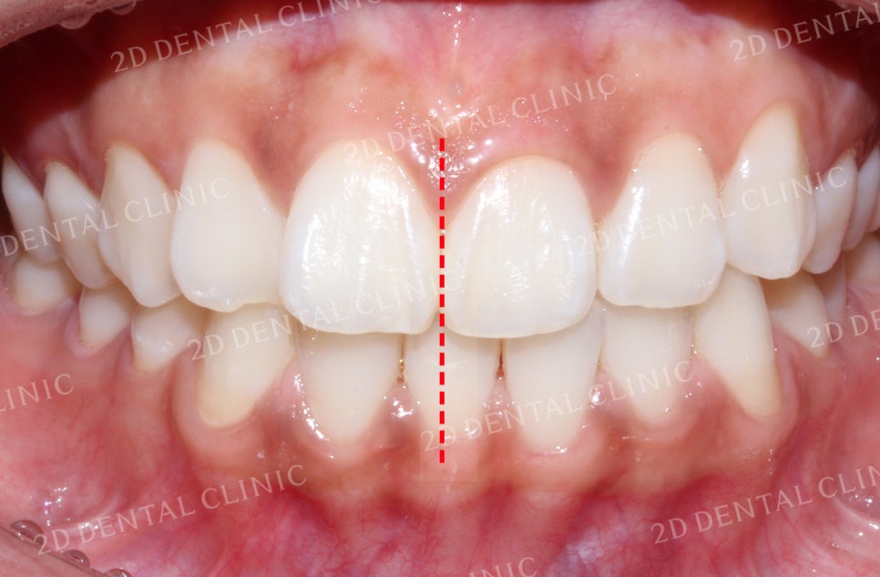 돌출입, 돌출앞니를 부분교정으로 고르게! by.투디치과(2D치과) 관련 이미지 2