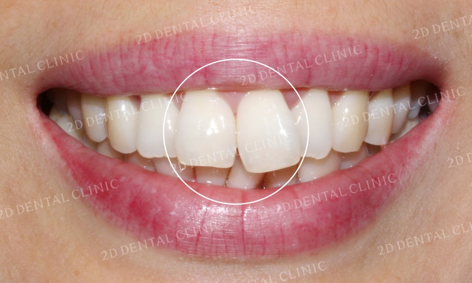 [앞니교정] 돌출앞니교정, 토끼앞니를 클리피씨교정으로 완성하기! by. 투디치과(2D치과) 관련 이미지 3