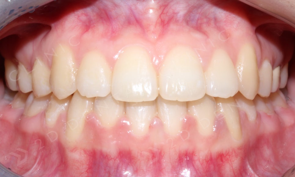 덧니만 부분교정으로 교정 할 수 있나요? 관련 이미지 8