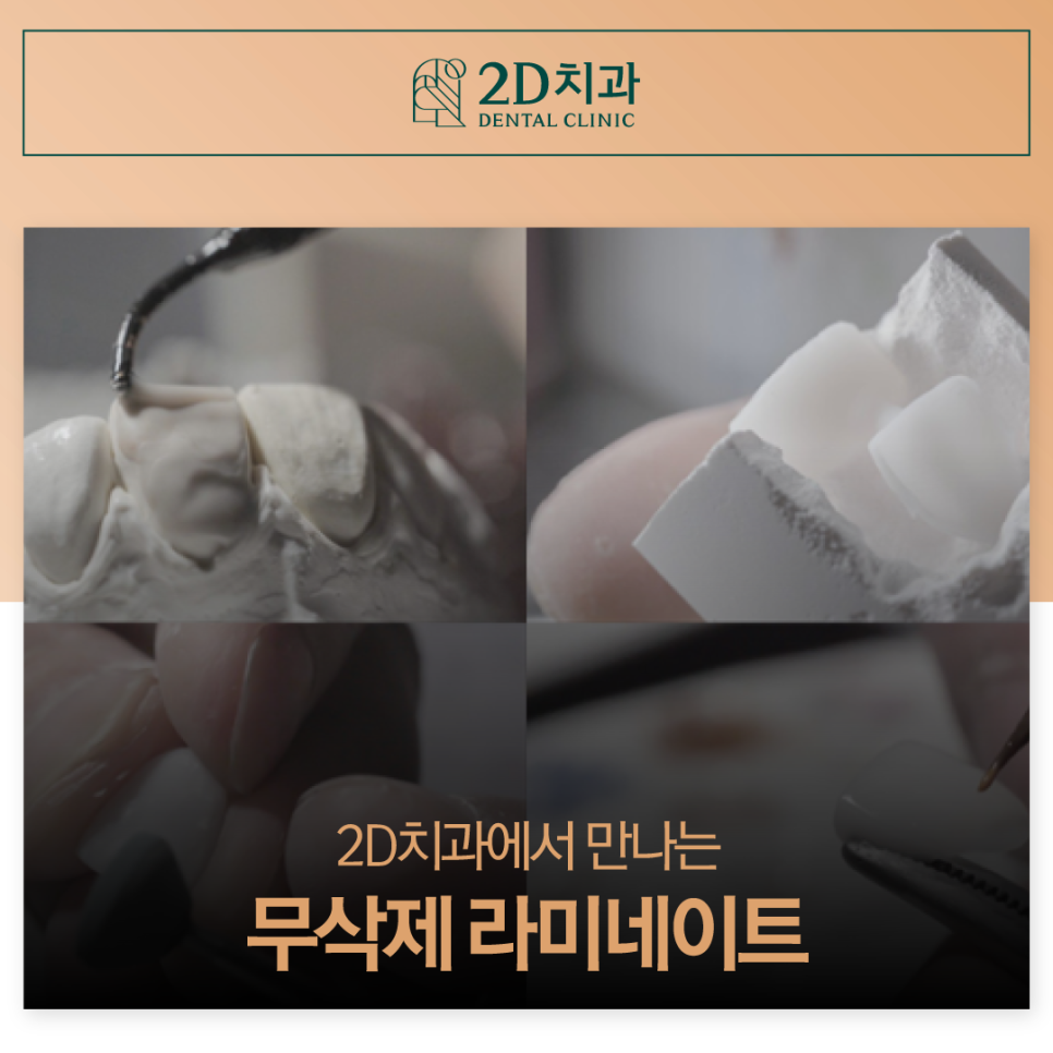 무삭제라미네이트가격 치아미백치과 앞니 고민 있다면 관련 이미지 1