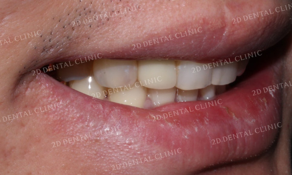 [2D교정] 나비치아교정을 2D교정 장치로 빠르게 완성하기! by.2D치과(투디치과) 관련 이미지 12
