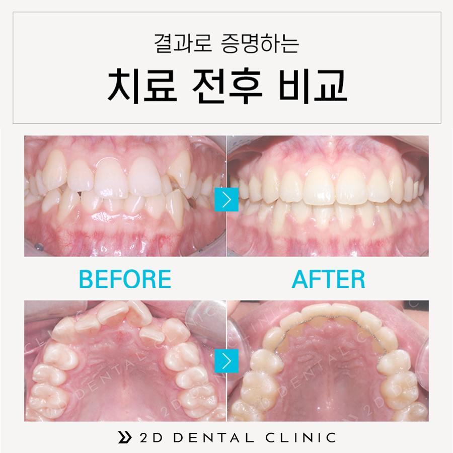 클리피씨 교정 가격 얼마일까? 강남 2D치과 관련 이미지 8