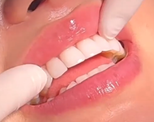 무삭제라미네이트 치아삭제없는 0.1mm 얇은 블랙필름 관련 이미지 12