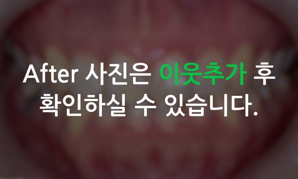 덧니교정 2D교정 (부분교정) 후기 관련 이미지 8