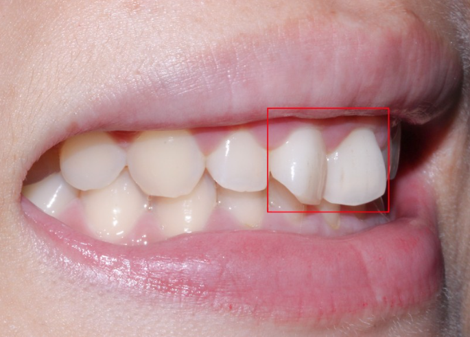옥니 라미네이트 치아고민은 그만 치아삭제 없는 블랙필름으로 해결 관련 이미지 3