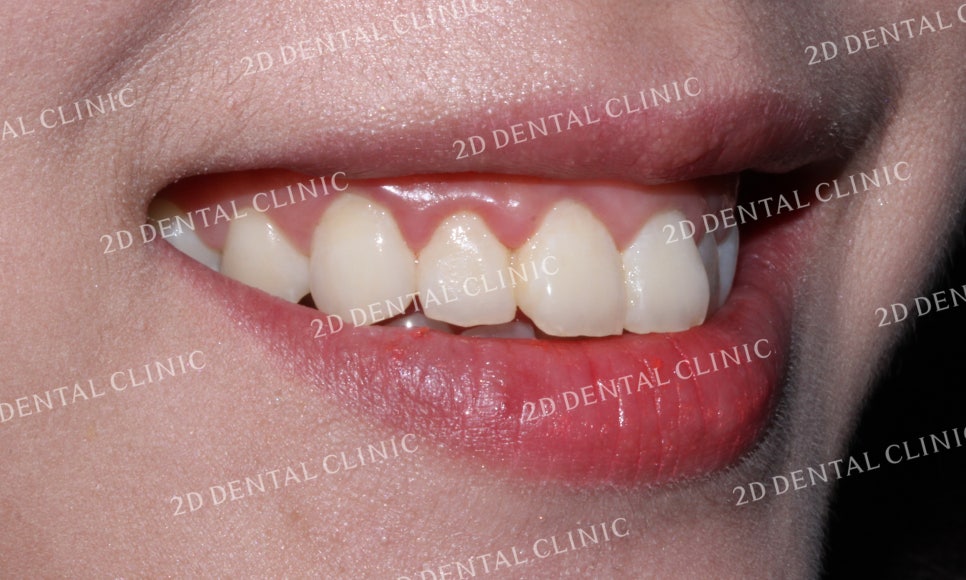 [투디교정] 덧니치아교정, 부분교정으로 쉽고 빠르게! by.투디치과(2D치과) 관련 이미지 4