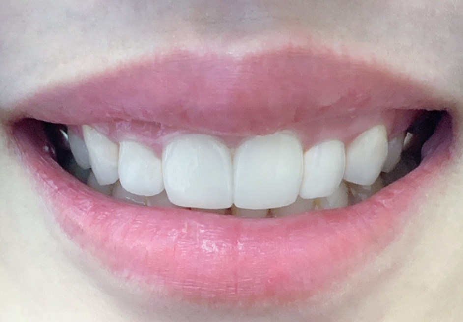 거미스마일 잇몸성형 강남라미네이트 2D치과 관련 이미지 4