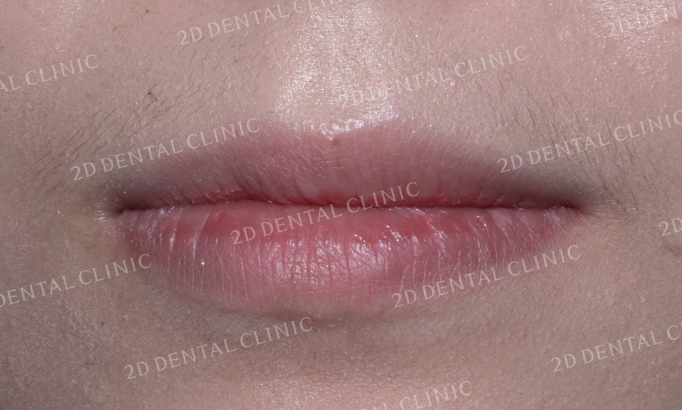 나비치아교정, 부분교정으로 나비치아 탈출하기! by.투디치과(2D치과) 관련 이미지 2