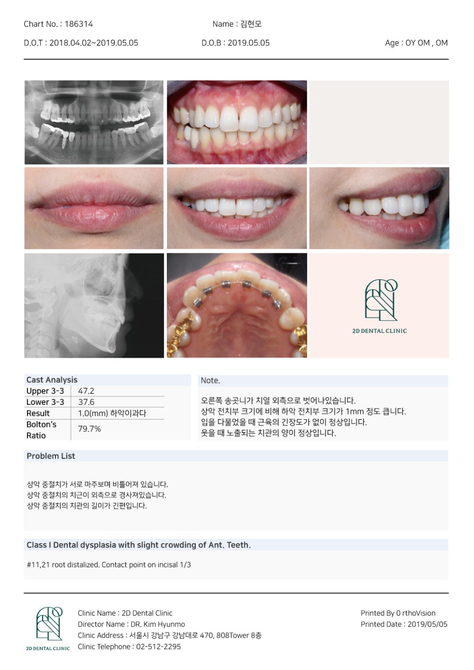토끼 이빨 치아교정 5개월 교정 완료! by. 투디치과(2D치과) 관련 이미지 5
