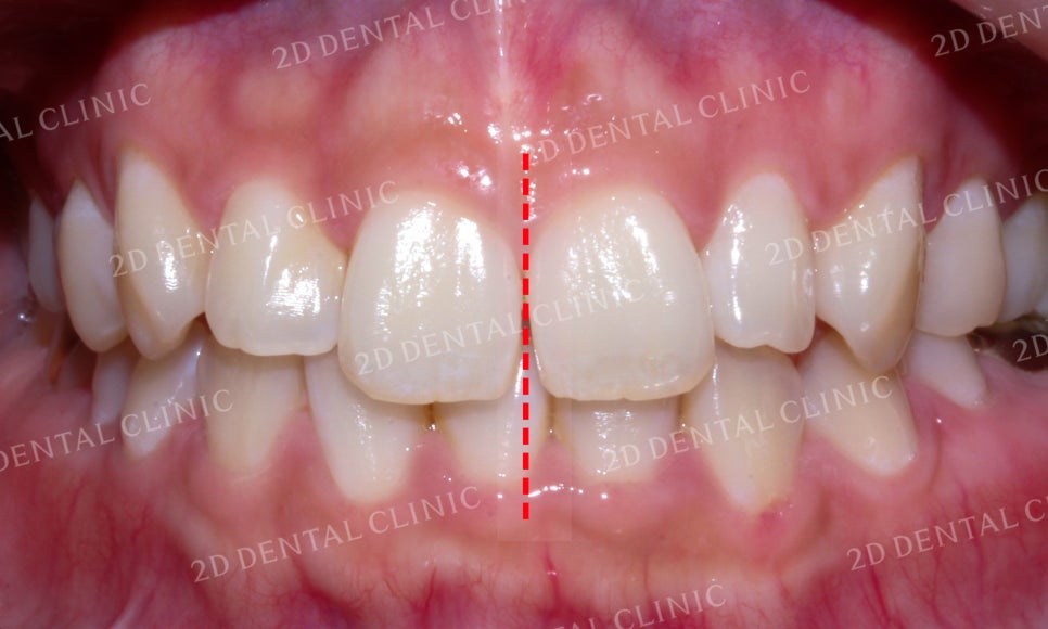 나비치아교정, 부분교정으로 나비치아 탈출하기! by.투디치과(2D치과) 관련 이미지 4
