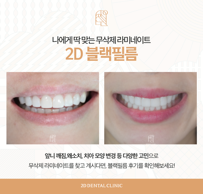 마취 필요 없는 블랙필름 무삭제라미네이트가격, 장점, 특징 관련 이미지 7