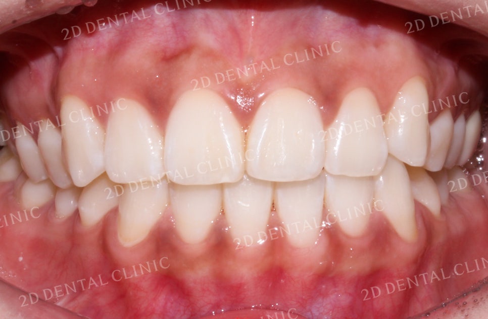 돌출입, 돌출앞니를 부분교정으로 고르게! by.투디치과(2D치과) 관련 이미지 11
