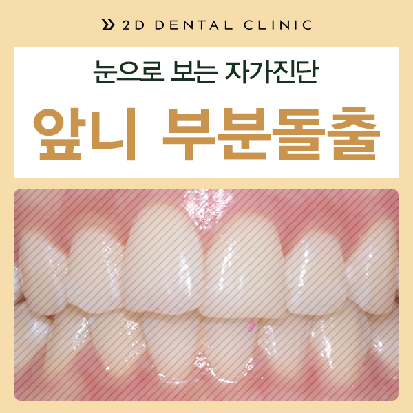 앞니 덧니 부분교정 케이스 전후비교, 교정전문 2D치과 관련 이미지 2