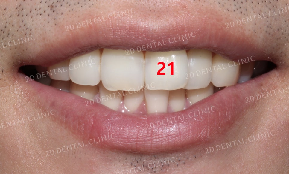 틀어진 앞니를 전체 교정으로 바르게! by.투디치과(2D치과) 관련 이미지 11