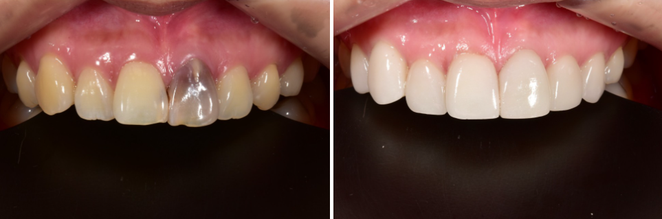 강남라미네이트치과 추천 : 진짜 무삭제, 투디치과! 관련 이미지 12