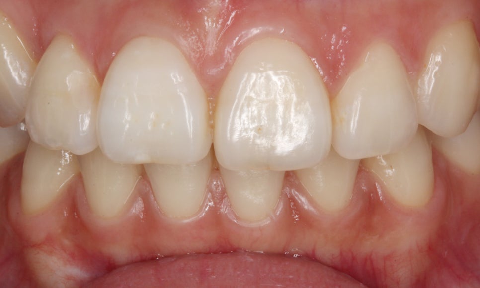 교정일기:앞니 부분 블링스(라미네이트) 심리보철 진료과정 후기 관련 이미지 3