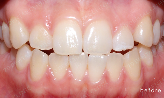 우디의 교정 일기ㅣ부정 교합 치아교정 후기 관련 이미지 2