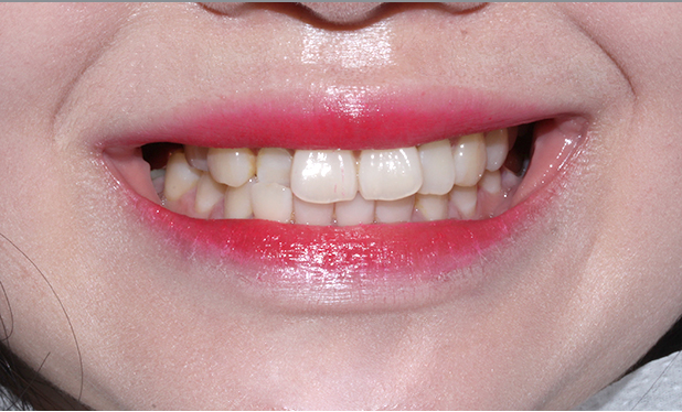 2D치과 2D교정으로 4개월만에 덧니 개선! 관련 이미지 6