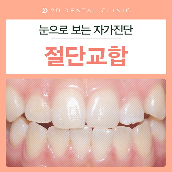 절단교합 교정 케이스 전후비교, 교정전문 2D치과 관련 이미지 2