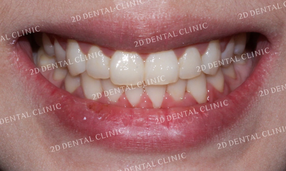 [투디교정] 덧니치아교정, 부분교정으로 쉽고 빠르게! by.투디치과(2D치과) 관련 이미지 10