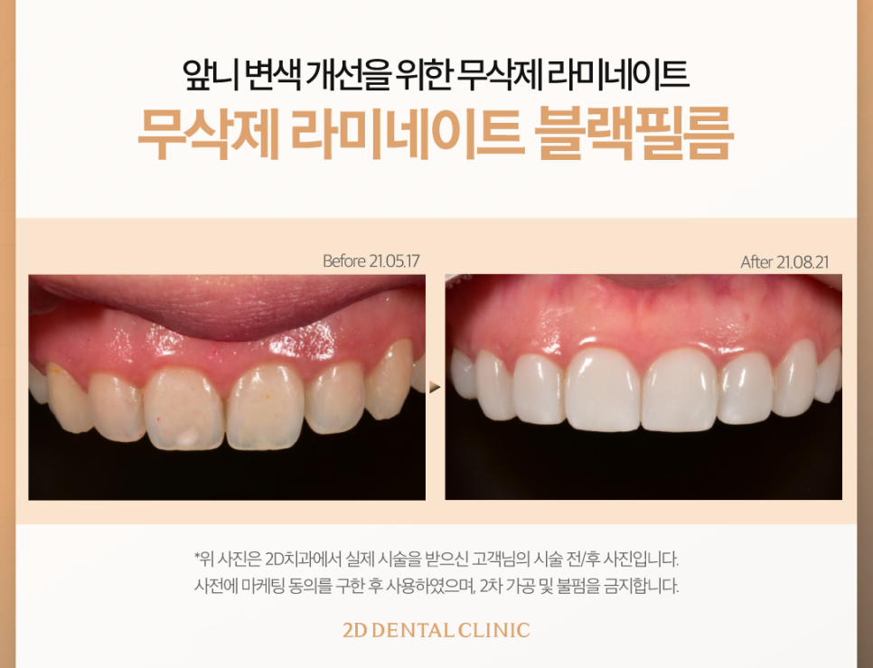 무삭제라미네이트후기 앞니변색 걱정 덜어내고 오래 사용할 수 있도록! 관련 이미지 6