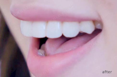 투디치과(2D치과)에서 직!접! 무삭제 쎄라필름을 한 리얼후기 관련 이미지 6