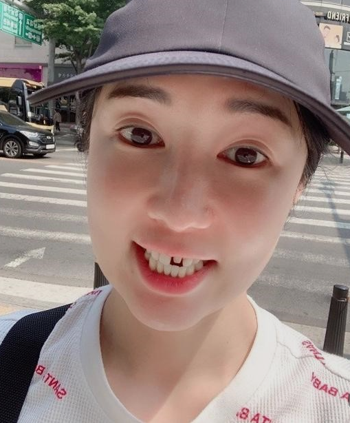 연예인라미네이트 균일하고 하얀치아를 원한다면 블랙필름 관련 이미지 3