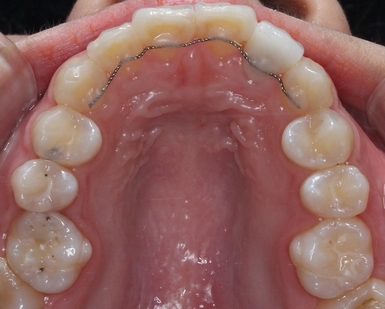 투명교정. 그것이 알고싶다! 관련 이미지 3