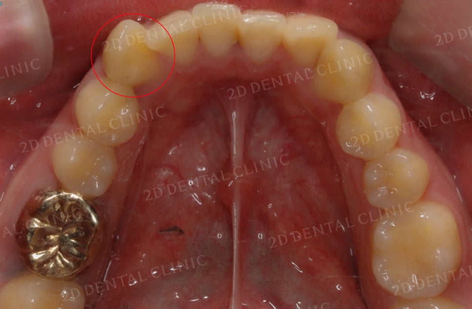 [앞니교정] 토끼앞니교정, 클리피씨 교정으로 완벽하게! by.투디치과(2D치과) 관련 이미지 7