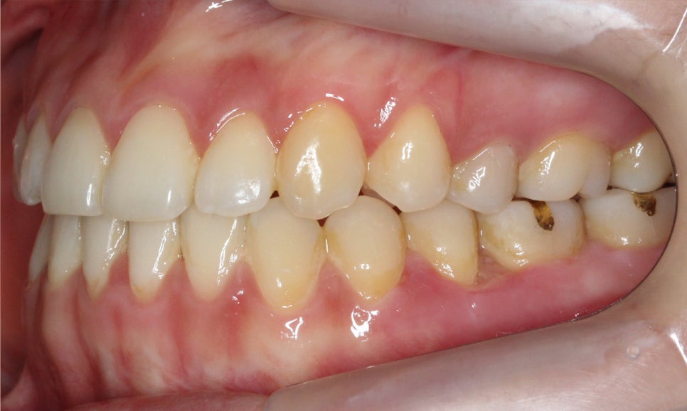 절단교합 클리피씨 교정 방법 관련 이미지 12