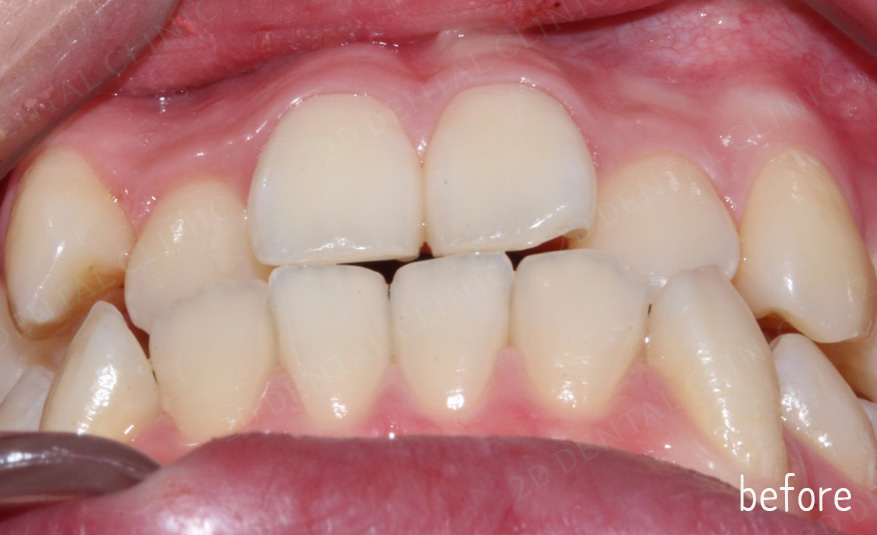 우디의 교정일기ㅣ덧니 치아교정 후기 (feat.부정교합) 관련 이미지 8