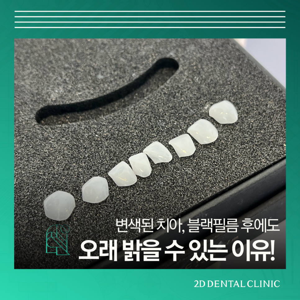 무삭제라미네이트부작용 치아부분변색 얼룩진 앞니 개선 관련 이미지 1