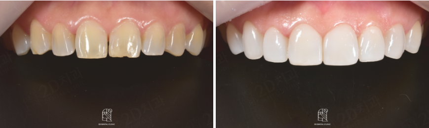 앞니깨짐 라미네이트로 자연스럽게! 관련 이미지 7