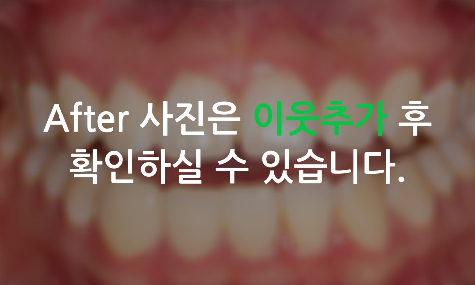 나비앞니 교정, 투디교정으로 빠르게 완성하는 방법! 관련 이미지 10